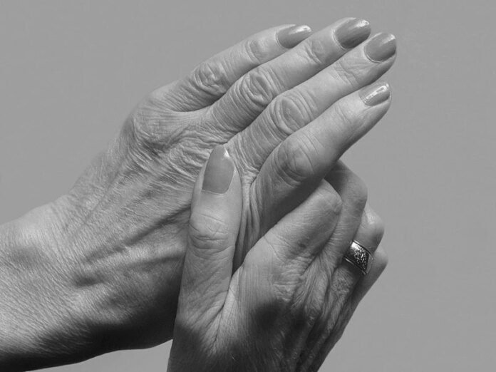 FDA Panel Votes to Approve Radiesse for Hand Augmentation