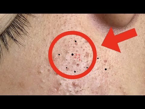 Facial Treatment for Acne. 🙂 Relaxing skin pimple removal blackheads. # 01