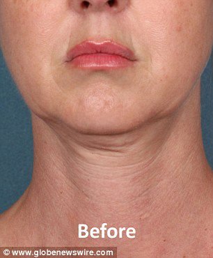 Fifty injections in a 15-minute treatment and up to six sessions.. so would you brave the flab jab to lose your double chin?