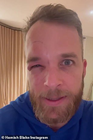 Hamish Blake looks unrecognisable after an allergic reaction to a bee sting