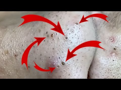 😍 Pimple blackhead Removal Acne facial treatment. Satisfying Video With Calming Deep Sleep Music.#11