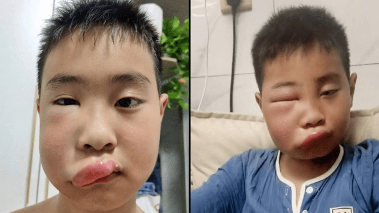 Boy’s face swells up massively as he’s attacked by bees after constantly poking their hive