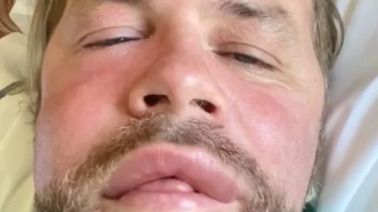 Westlife’s Brian McFadden unrecognisable after bee sting