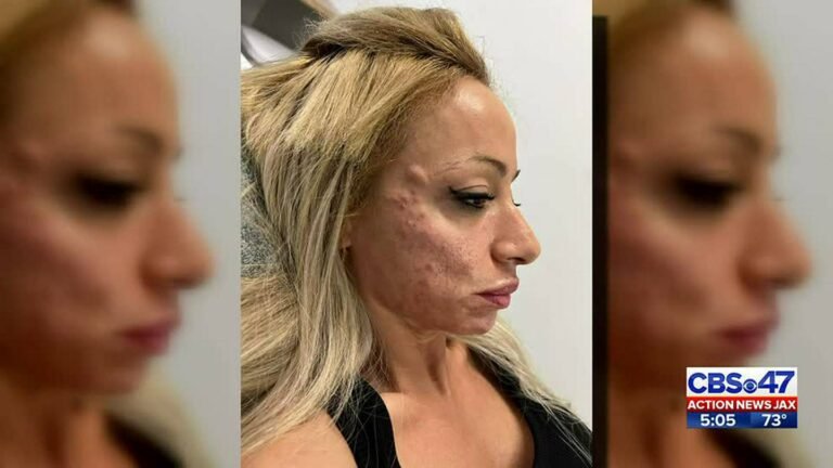 ‘Botox bandit:’ Woman returns to pay nearly $2,600 botox bill at Jacksonville Beach med spa – 104.5 WOKV