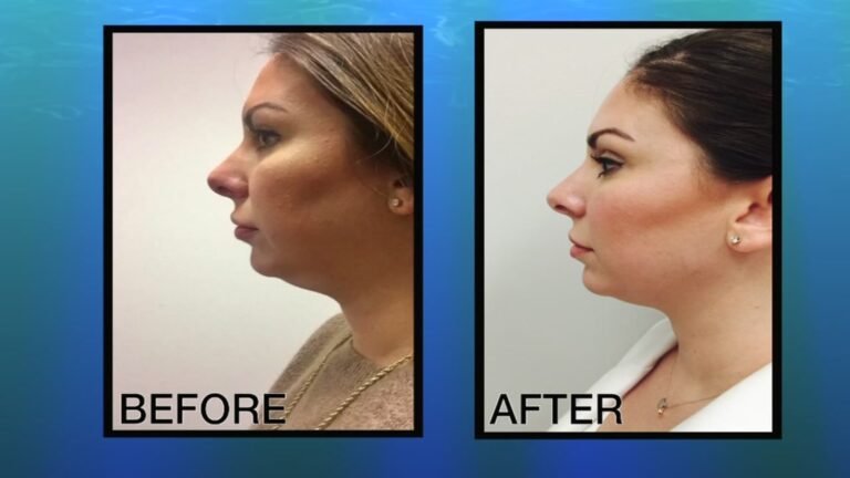 Chin up! How to slim down your double chin