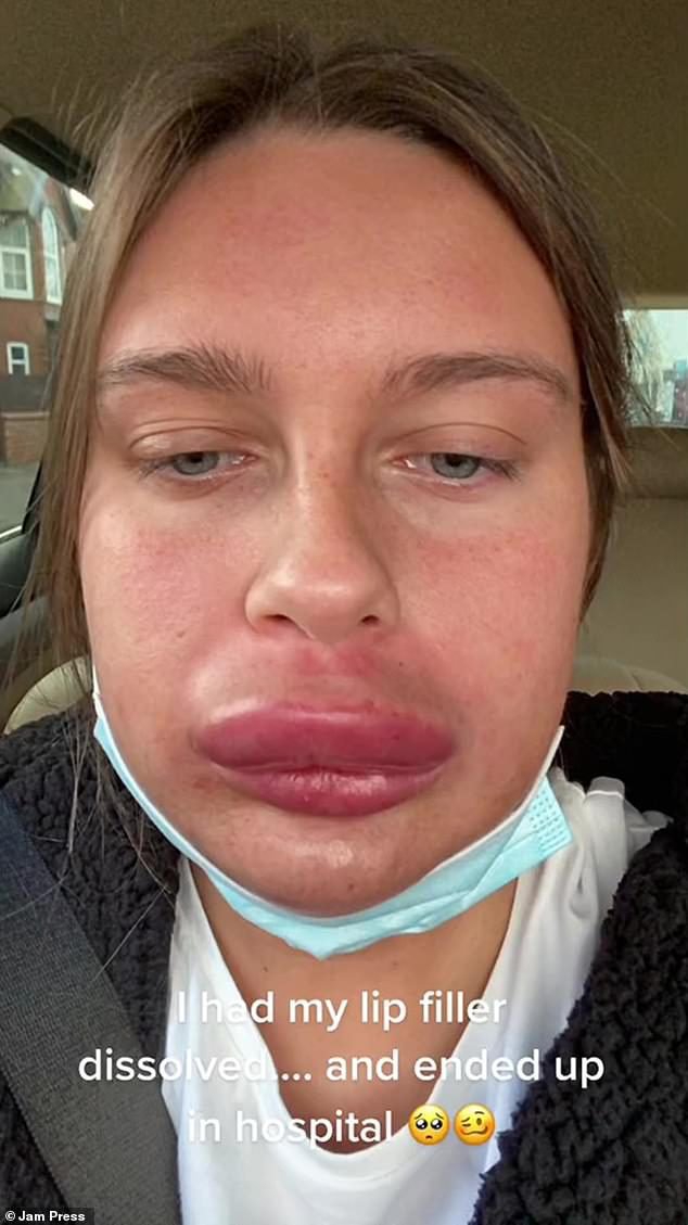 Horror as 23-year-old woman ends up ‘looking like Donald Duck’ after getting her fillers removed