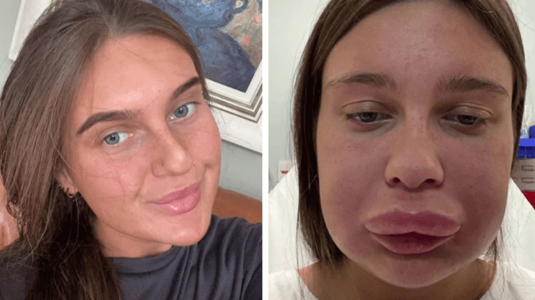 Woman rushed to hospital and left ‘looking like Donald Duck’ after getting lips dissolved