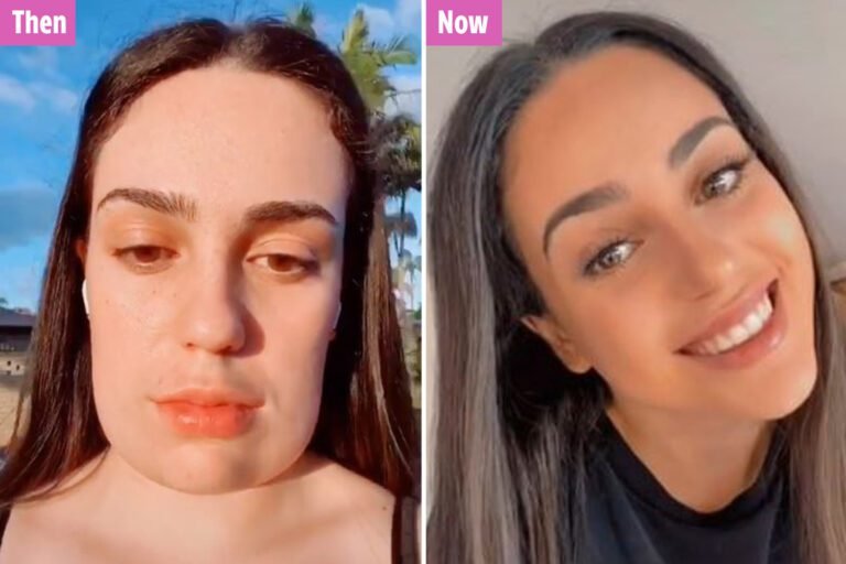 Teen who ‘ended up with a square head’ after chin fat removal surgery shows off her final look eights weeks later