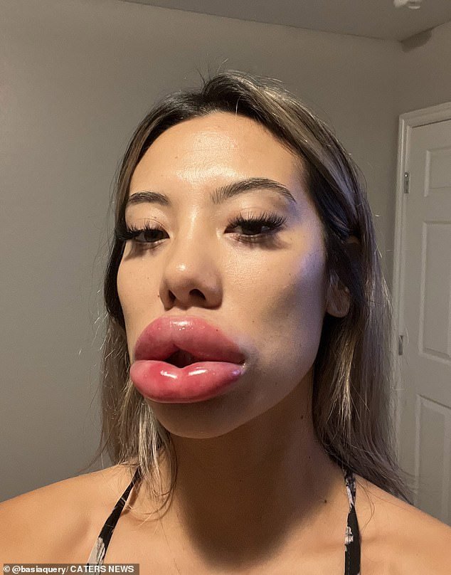 Woman’s lips ballooned to triple their size after allergic reaction to $350 discount fillers