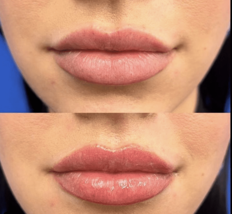 The “Laser Lip FIip” Is the New, Needle-Free Way to Plump Thin Lips