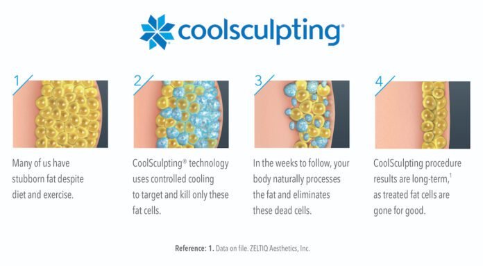 What to know about CoolSculpting® – Beaufort South Carolina The Island News
