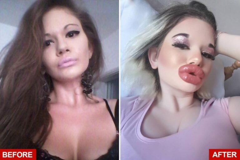 Woman with ‘world’s biggest lips’ is getting more injections
