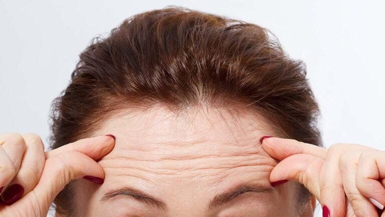 How To Get Rid of Forehead Wrinkles
