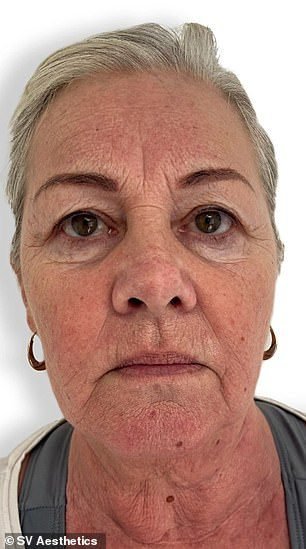 Woman, 60, reveals incredible transformation after undergoing non-surgical facelift