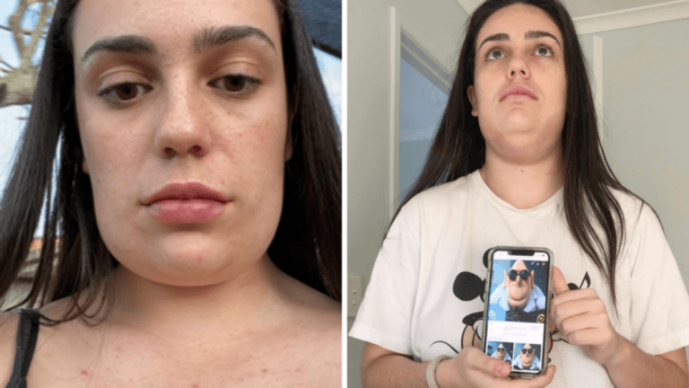 Gold Coast woman who got ‘square head’ after Kybella fat dissolving treatment shares transformation photos