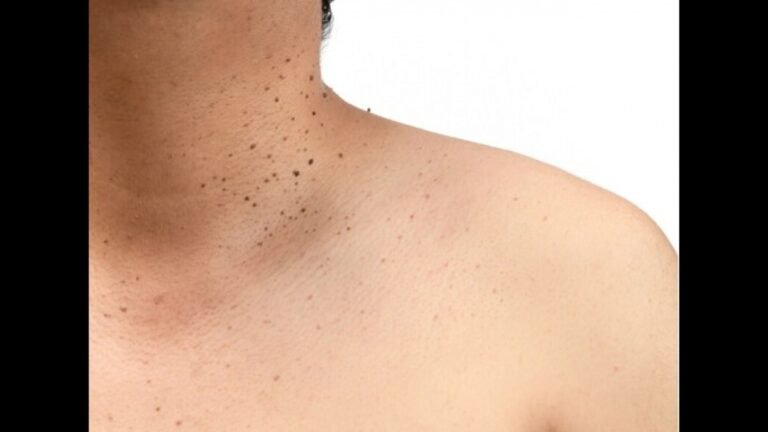 Top 3 Over The Counter Skin Tag Removal Products