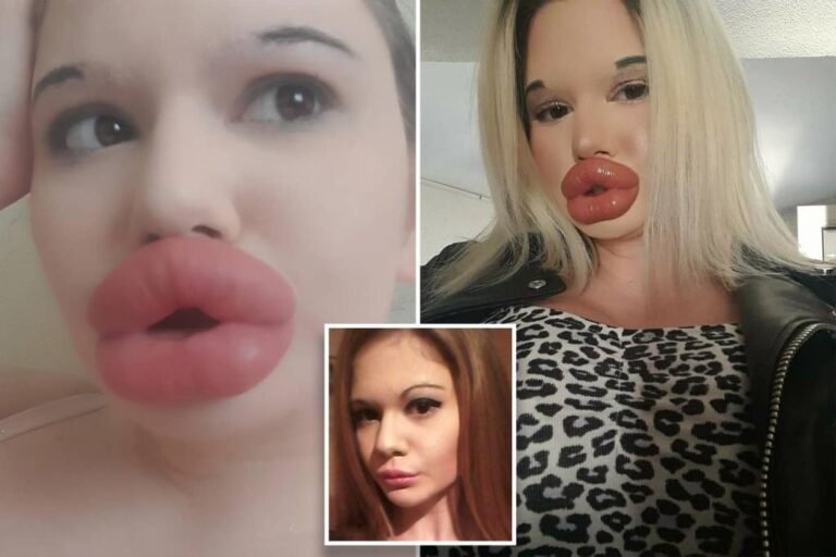 I’m addicted to my big lips — doctors say I could die but I won’t stop
