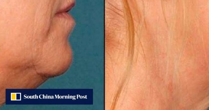 More fat profits? The makers of Botox say they have a cure for your double chin - South China Morning Post