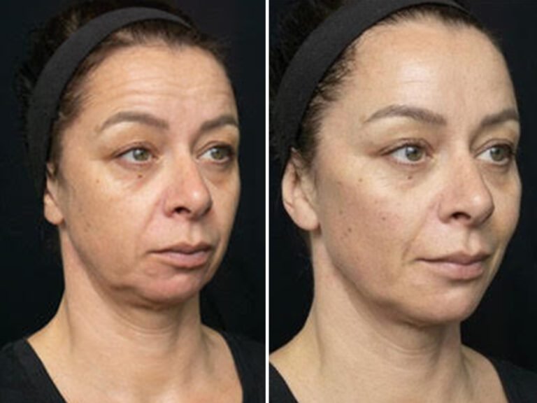 The New ‘Revolutionary’ Rejuvenation Procedure That Can Transform Your Face