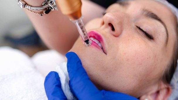 TikTok, phony doctors to blame for dangerous DIY lip filler trend: Experts