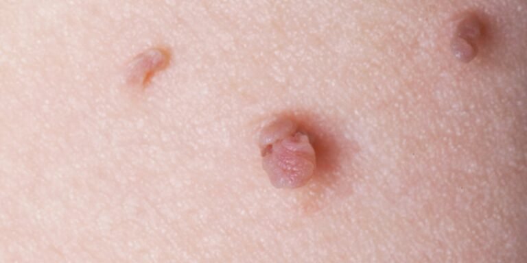 How to Remove Skin Tags, According to Dermatologists