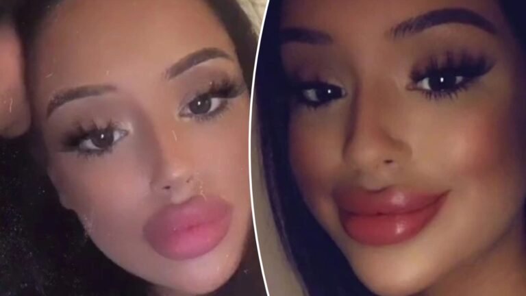 I got addicted to lip filler and had it 20 times in two years – it was a total error, now I hate it & need it dissolved