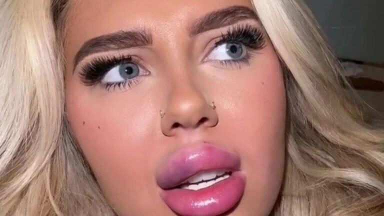 I had my lip fillers dissolved but I missed them so had them redone – people say I’ve got ‘hot dog lips’ but I love them