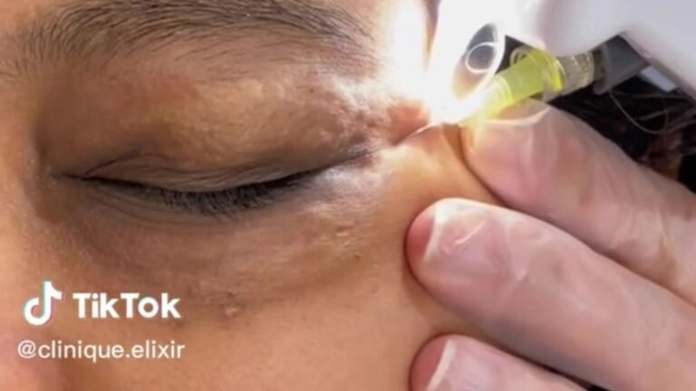 Beauty guru shows how she gets rid of her client’s dark circles without Botox or filler… so would YOU brave it?
