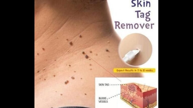 Bliss Skin Tag Remover (SCAM ALERT) Review 2023 Bliss Skin Tag Removal Dangers Exposed
