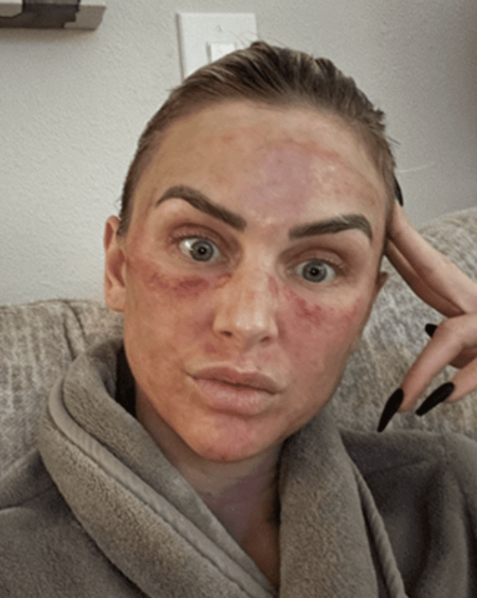 Lala Kent Shares Bruised 'After' Pics of Her Under-Eye Filler Alternative