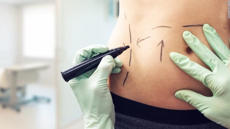 Liposuction overtakes breast implants as world’s most popular cosmetic surgery