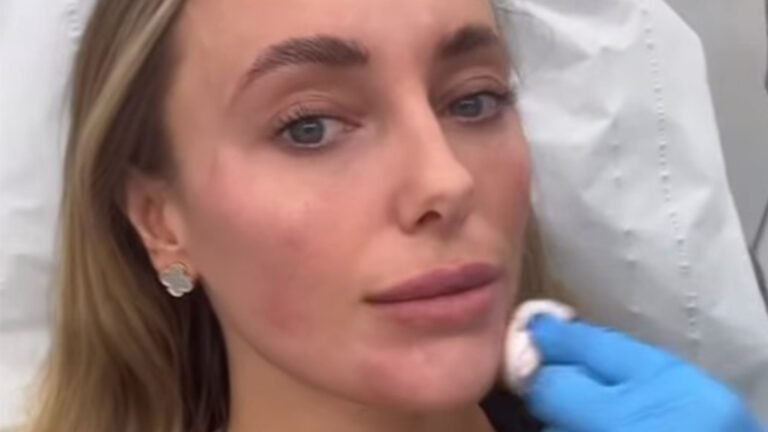 Towie star Amber Turner shows off bruised swollen face as she gets ‘tweaks’ ahead of new series