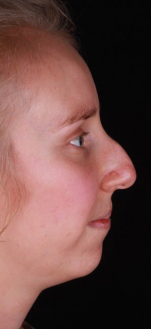 Woman, 27, praises £575 non-surgical nose job as she shares incredible before and after shots