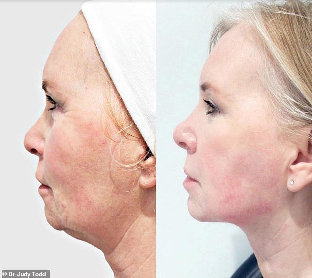 Woman looks TEN years younger after undergoing new non-surgical facelift