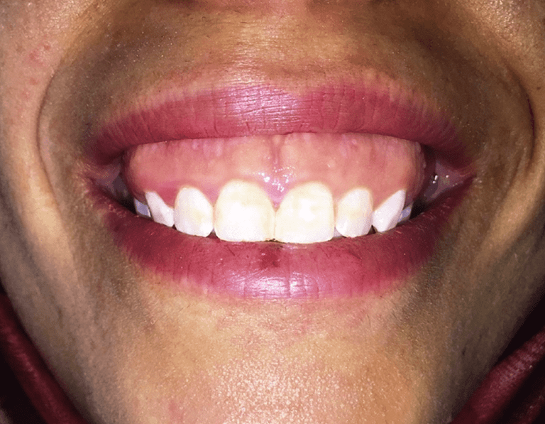 An Approach for Gummy Smile Treatment Using Botulinum Toxin A: A Narrative Review of the Literature